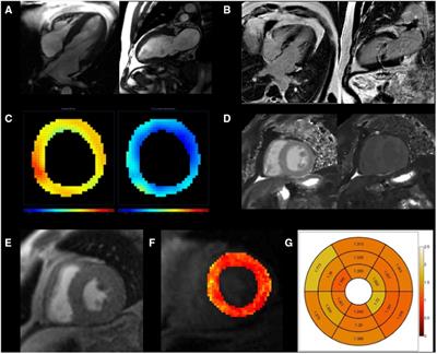 Cardiometabolic biomarker patterns associated with cardiac MRI defined fibrosis and microvascular dysfunction in patients with heart failure with preserved ejection fraction